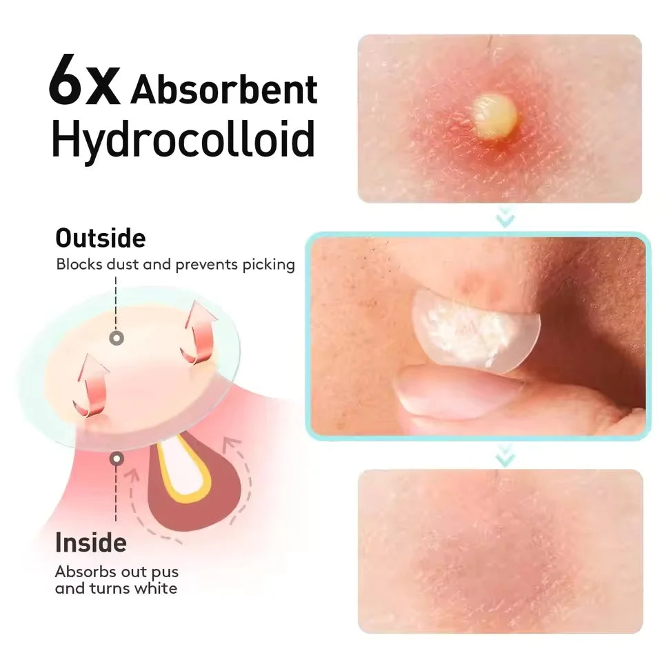 720/360/180 pieces/box of transparent hydrogel acne patches, alcohol free, gentle and non irritating absorption acne patches
